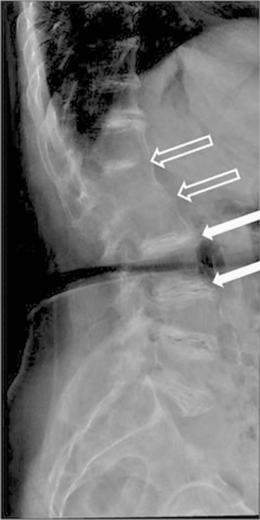 Lateral lumbar spine radiograph with white arrows showing dense intervertebral disc calcification and disc-space narrowing in ochronosis