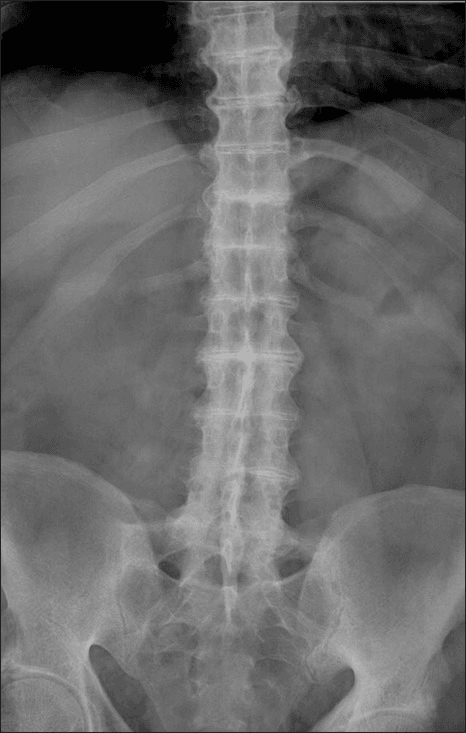 Frontal AP radiograph of lumbar spine and pelvis showing multilevel disc-space narrowing and degenerative change in ochronosis