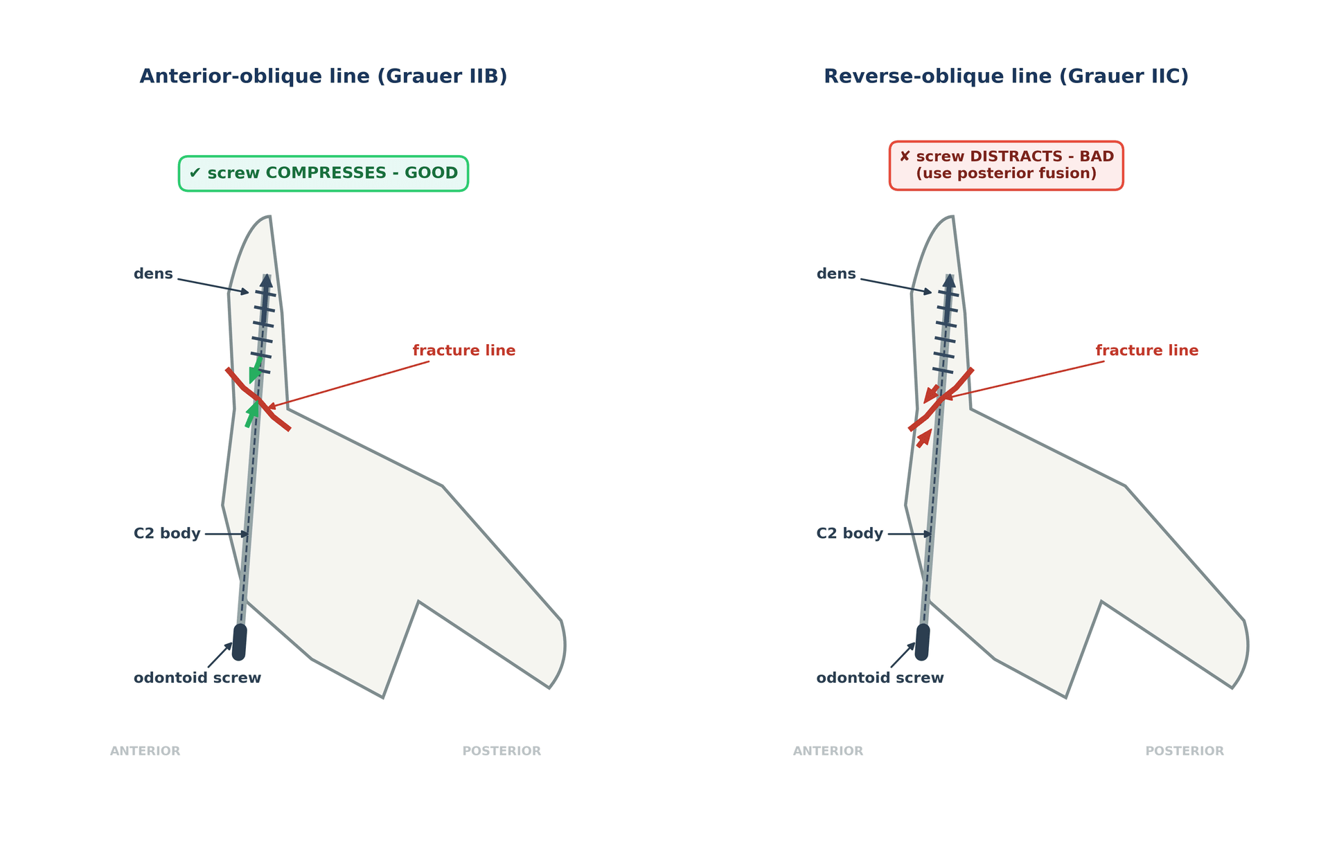 Two lateral C2 diagrams showing how an anterior-oblique versus reverse-oblique Type II fracture line determines whether an anterior odontoid screw compresses or distracts the fracture