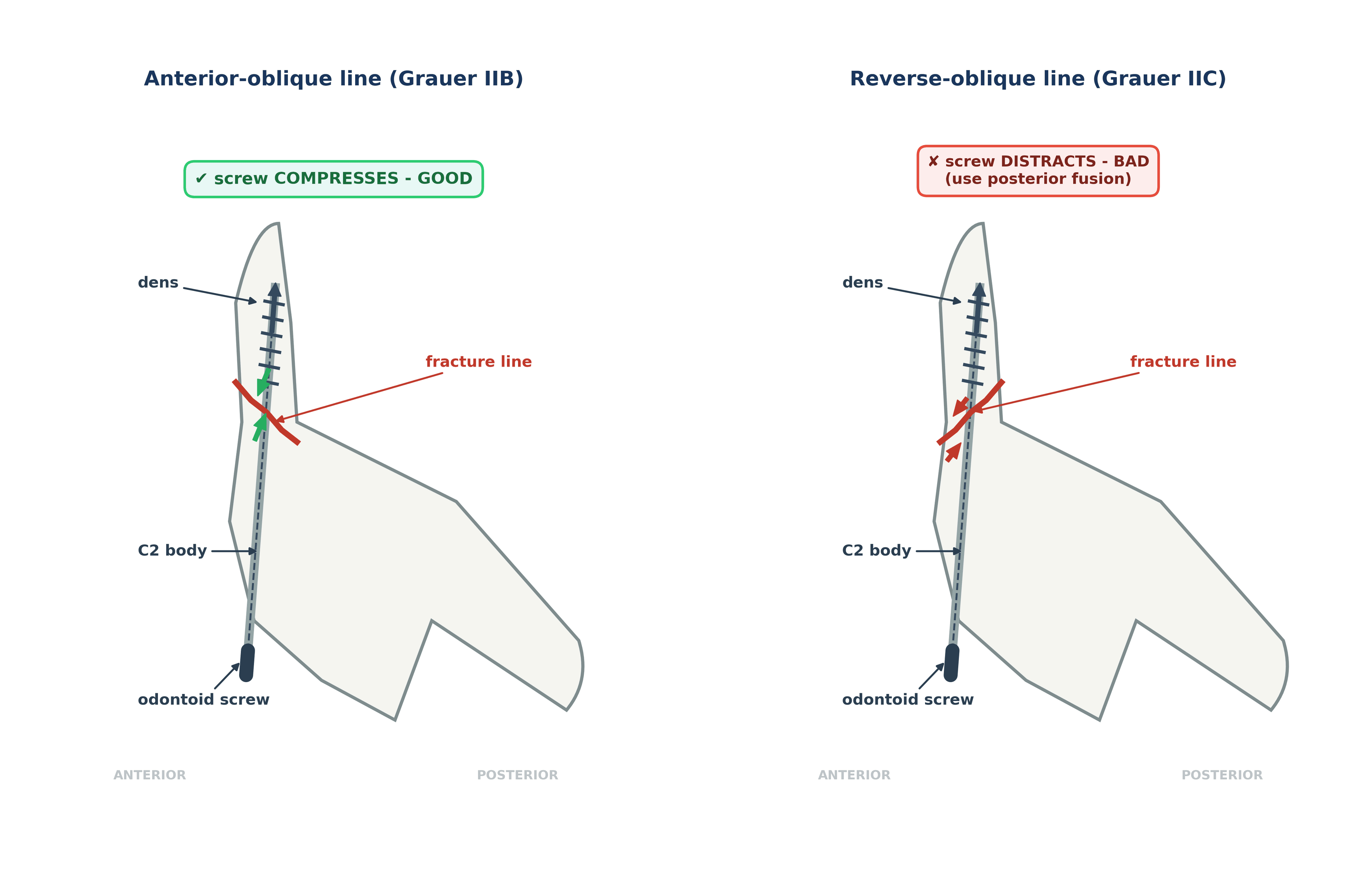 Two lateral C2 diagrams showing how an anterior-oblique versus reverse-oblique Type II fracture line determines whether an anterior odontoid screw compresses or distracts the fracture