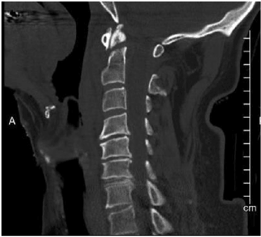 Sagittal CT of Type II odontoid fracture