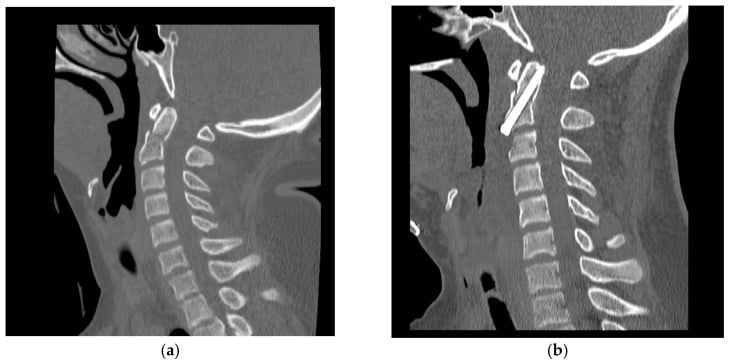 Preoperative displaced Type II odontoid fracture CT and postoperative CT after anterior odontoid screw fixation