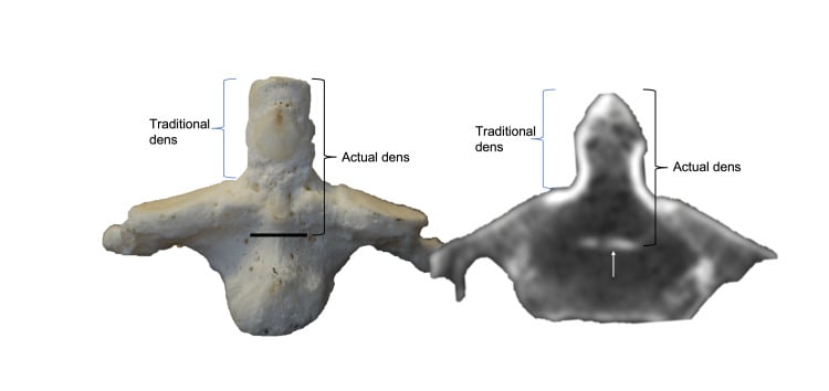 Anterior dry-bone and CT views of C2 comparing the traditional dens boundary with the embryological subdental synchondrosis