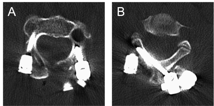 Axial postoperative CT demonstrating C2 pars, pedicle and intralaminar screw trajectories around a high-riding vertebral artery