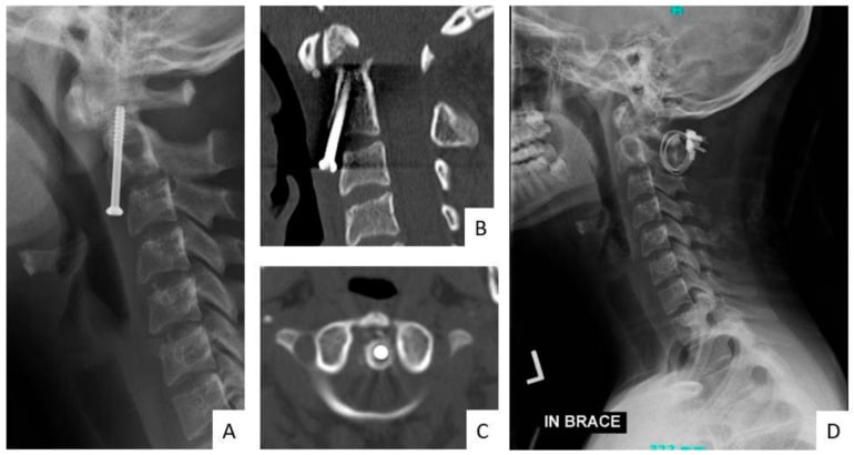 Serial fluorographs, CT and radiographs showing delayed anterior odontoid screw loosening and subsequent posterior revision fixation