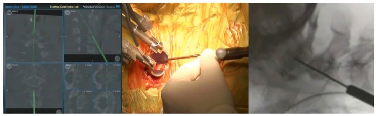 Navigation workstation, anterior odontoid screw entry-point exposure and lateral fluoroscopic trajectory confirmation