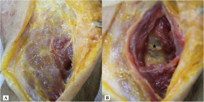 Posterior muscle-splitting operative exposure showing the nuchal interval and deeper upper-cervical corridor