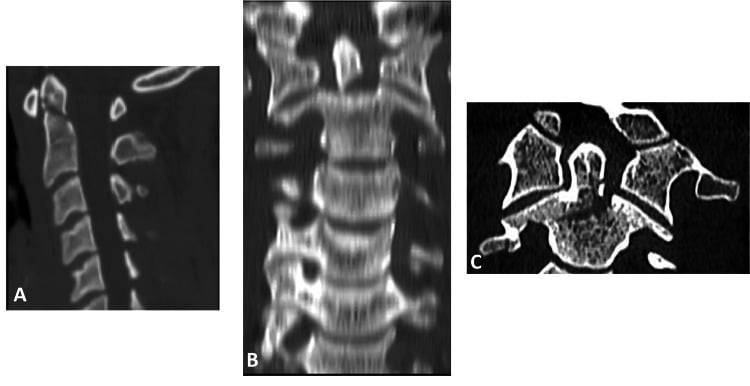Sagittal CT examples of Type I, Type II and Type III odontoid fractures