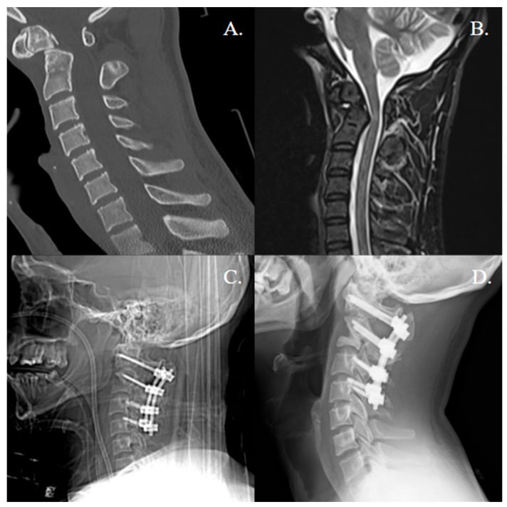 Type II odontoid fracture shown on sagittal CT and MRI with posterior C1-C2 fixation and follow-up fusion imaging