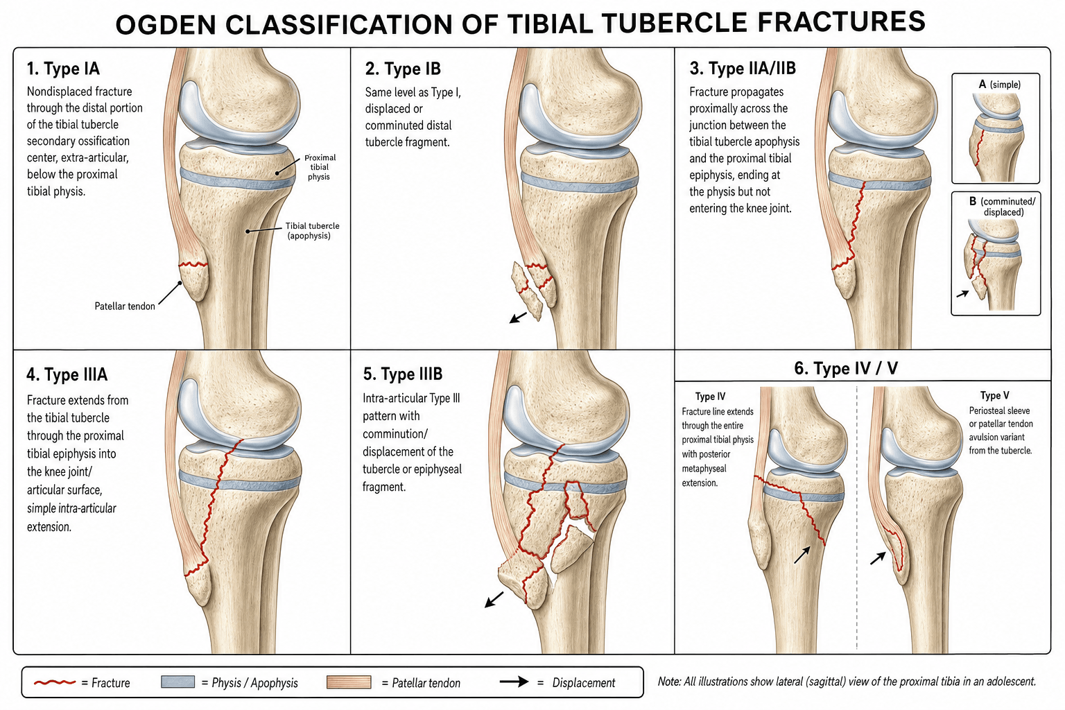 Ogden Classification of Tibial Tubercle Fractures