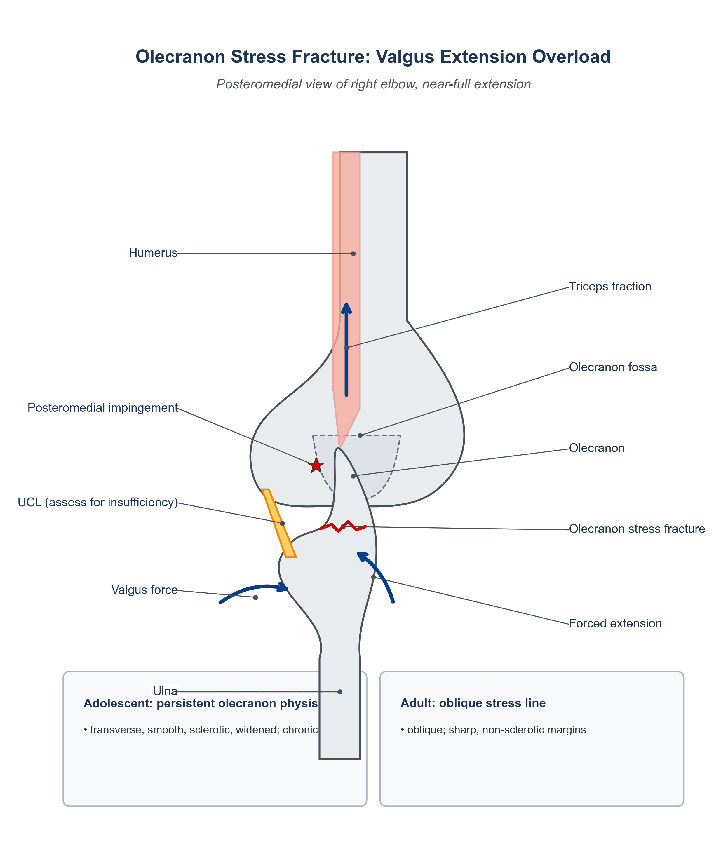 Schematic of the elbow in extension showing valgus extension overload: triceps traction, valgus force and forced extension driving the olecranon into its fossa (posteromedial impingement) and producing an olecranon stress fracture, with the two radiographic patterns