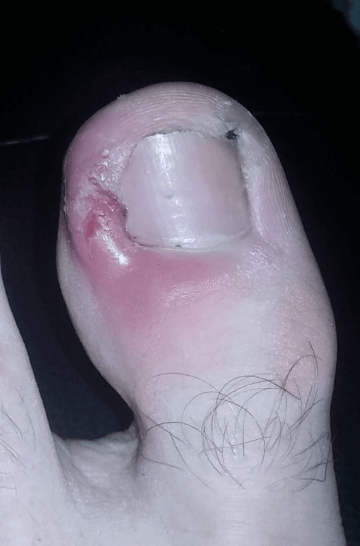 Clinical photograph of a great toe with an ingrown toenail showing an inflamed, erythematous, swollen lateral nail fold