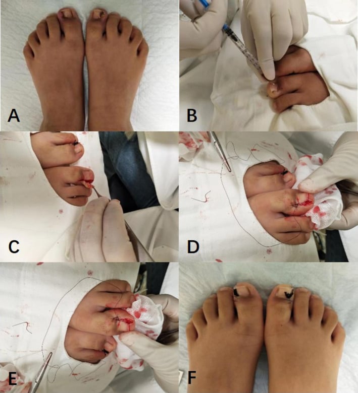 Six-step sequence of wedge excision, nail-fold fixation and nail-sulcus reconstruction for advanced onychocryptosis