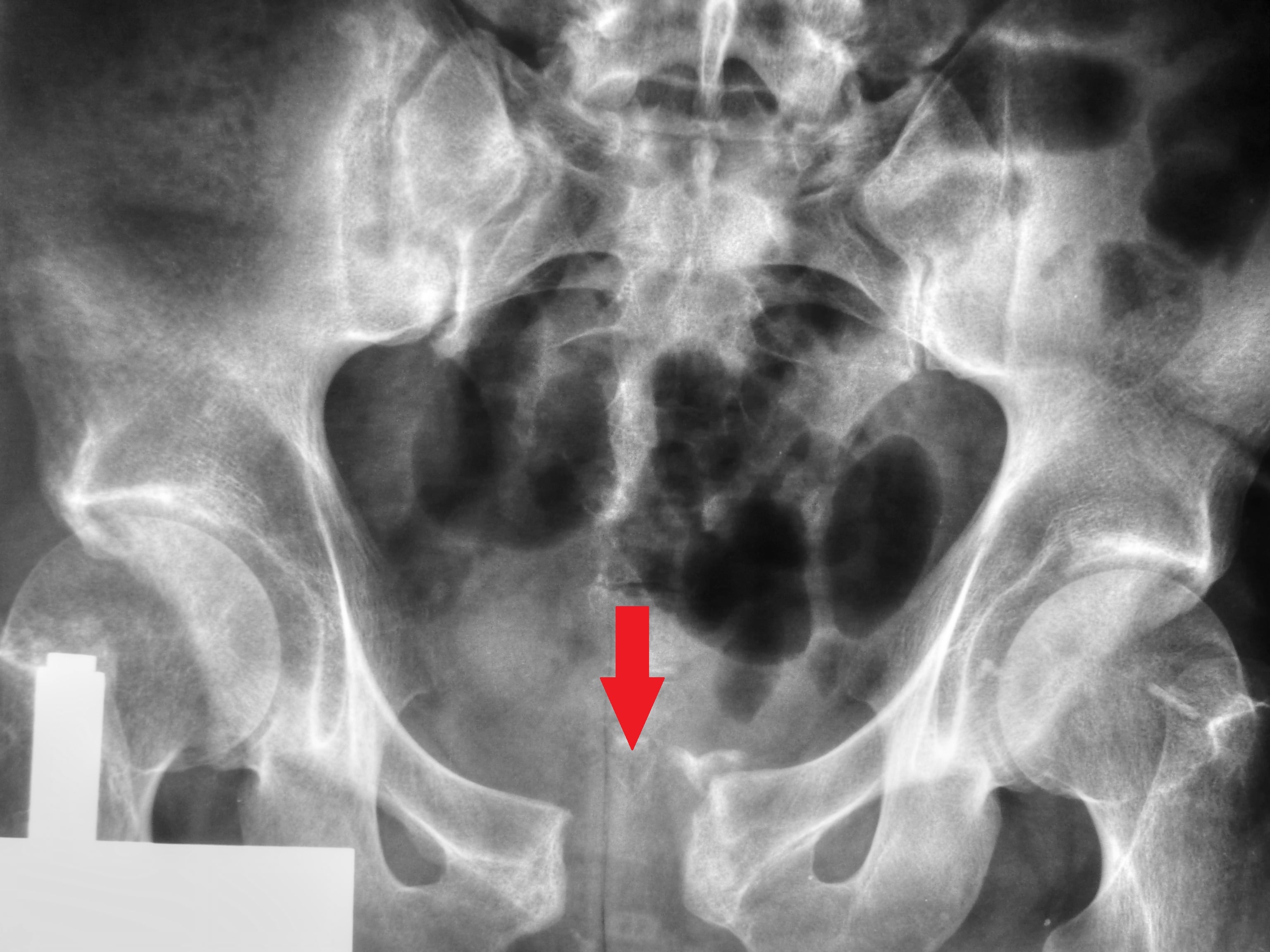 AP pelvis radiograph showing widening of the pubic symphysis (diastasis) from an open-book anteroposterior-compression pelvic ring injury.