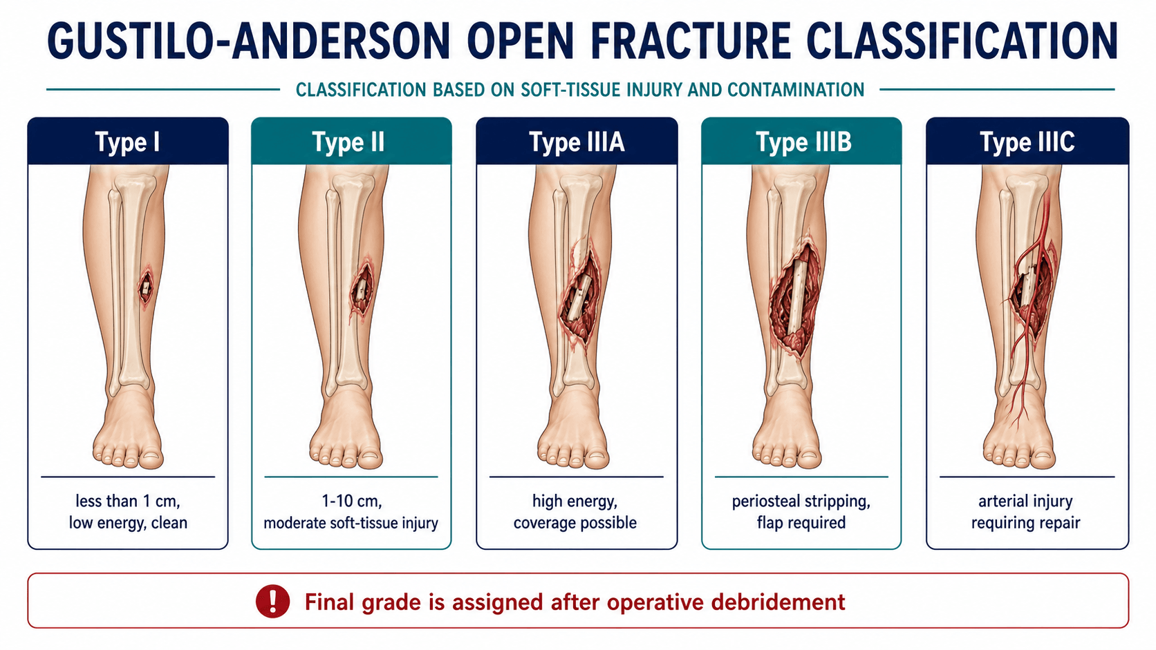 Gustilo-Anderson open fracture classification diagram with Type I, II, IIIA, IIIB and IIIC