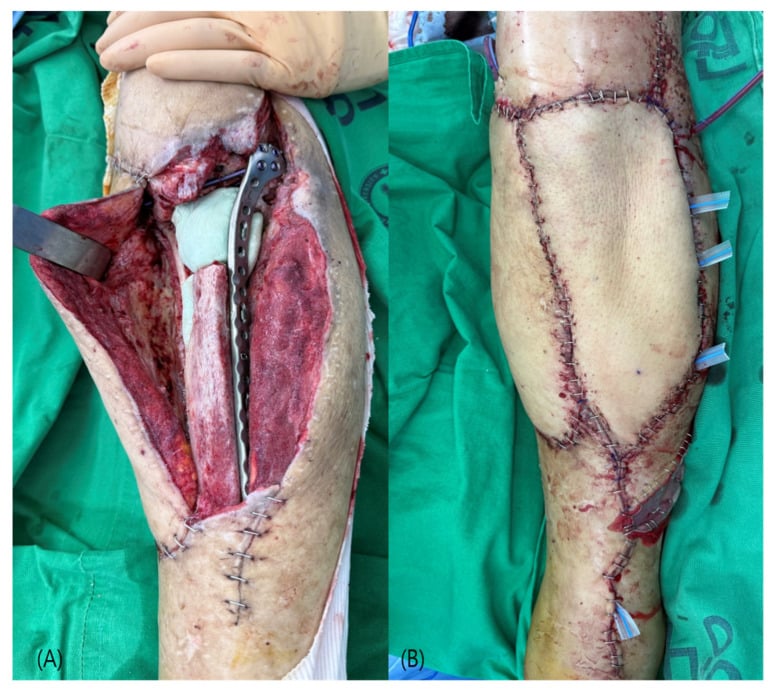 Proximal tibial defect with exposed bone and plate after debridement followed by anterolateral-thigh free-flap coverage