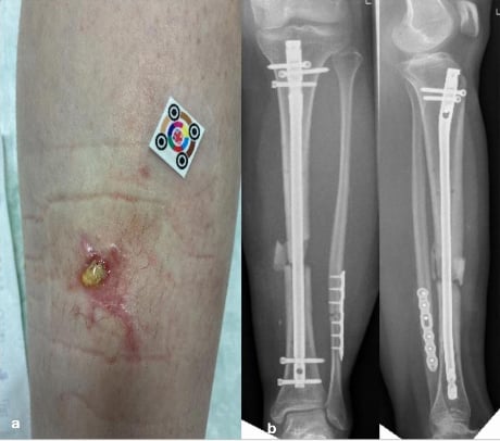 Draining sinus over a previously fixed open tibial fracture with AP and lateral radiographs showing retained implants