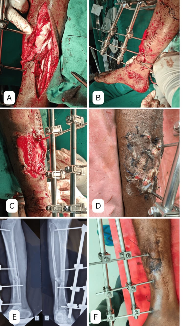 Open tibial wound covered with combined medial gastrocnemius and hemisoleus flaps and split-thickness skin graft