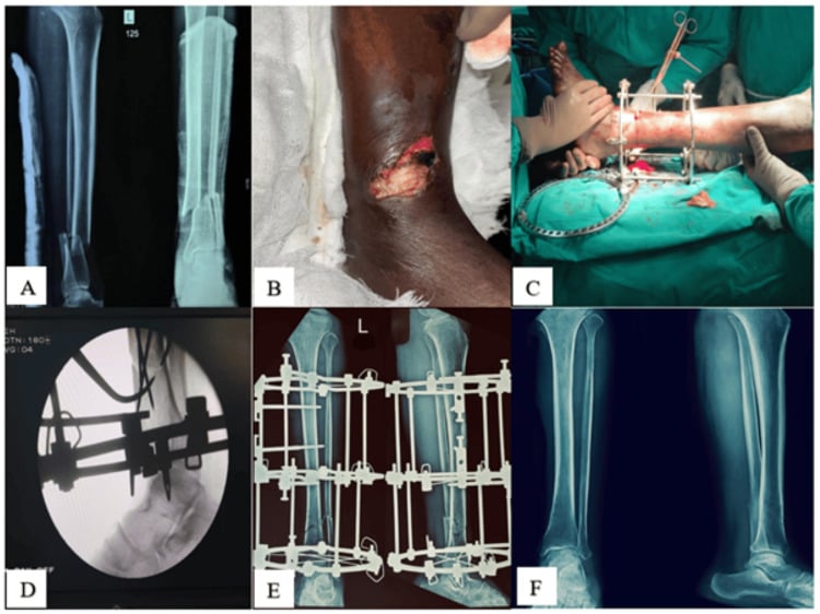 Radiographic, clinical, intraoperative and follow-up sequence of a Gustilo IIIB open tibial fracture treated with an Ilizarov frame