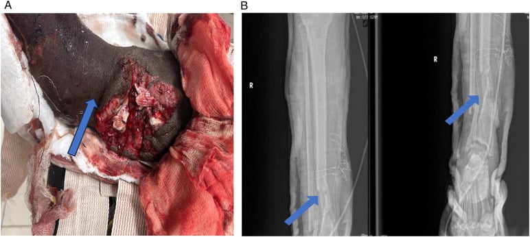 Open distal tibial gunshot wound with exposed bone beside AP and lateral radiographs showing a comminuted tibia and fibula fracture