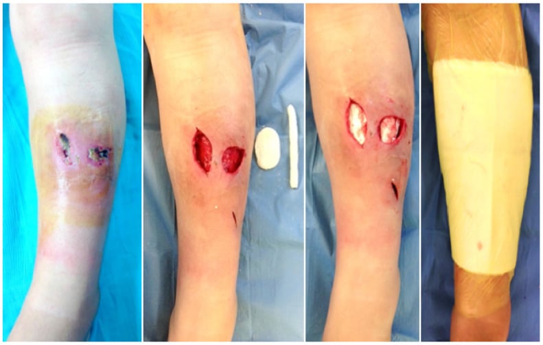Debridement sequence with vancomycin-gentamicin PMMA beads and a sealed bead-pouch dressing over a tibial infection