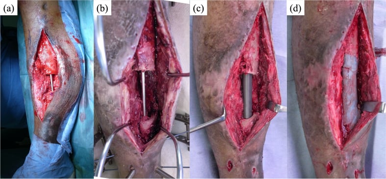 Operative sequence showing antibiotic cement spacer placement, later removal, intramedullary fixation and bone grafting of an infected tibial defect