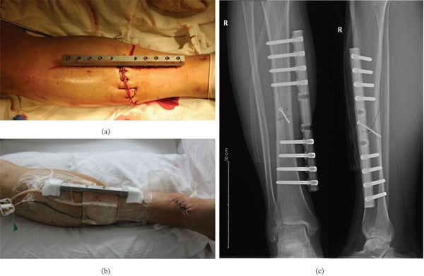 Temporary external fixation, negative-pressure dressing and postoperative radiographs of an open tibial fracture