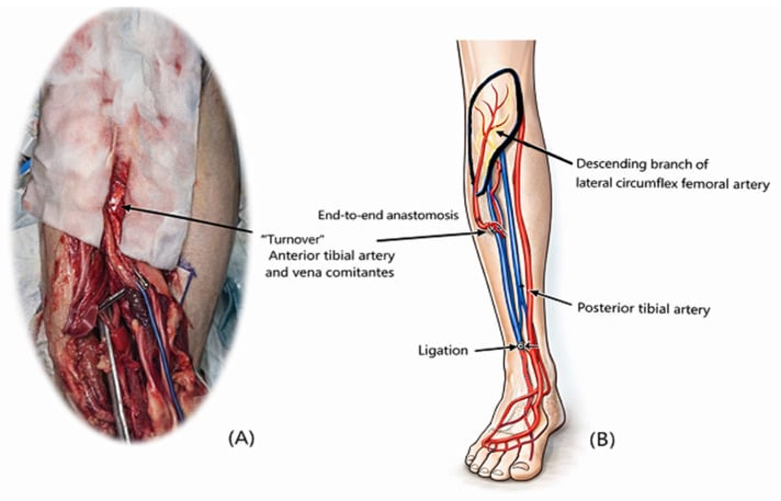 Operative photograph and schematic of turnover anterior tibial recipient vessels for lower-limb free-flap anastomosis