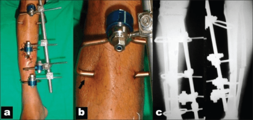 Three-panel image of a pinless external fixator on an open tibial fracture, a clamp site and an aligned radiograph.