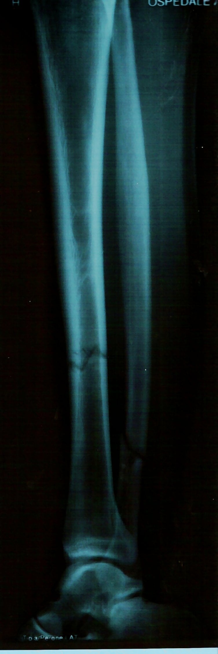 AP radiograph of the lower leg showing fractures of both the tibia and fibula shafts.