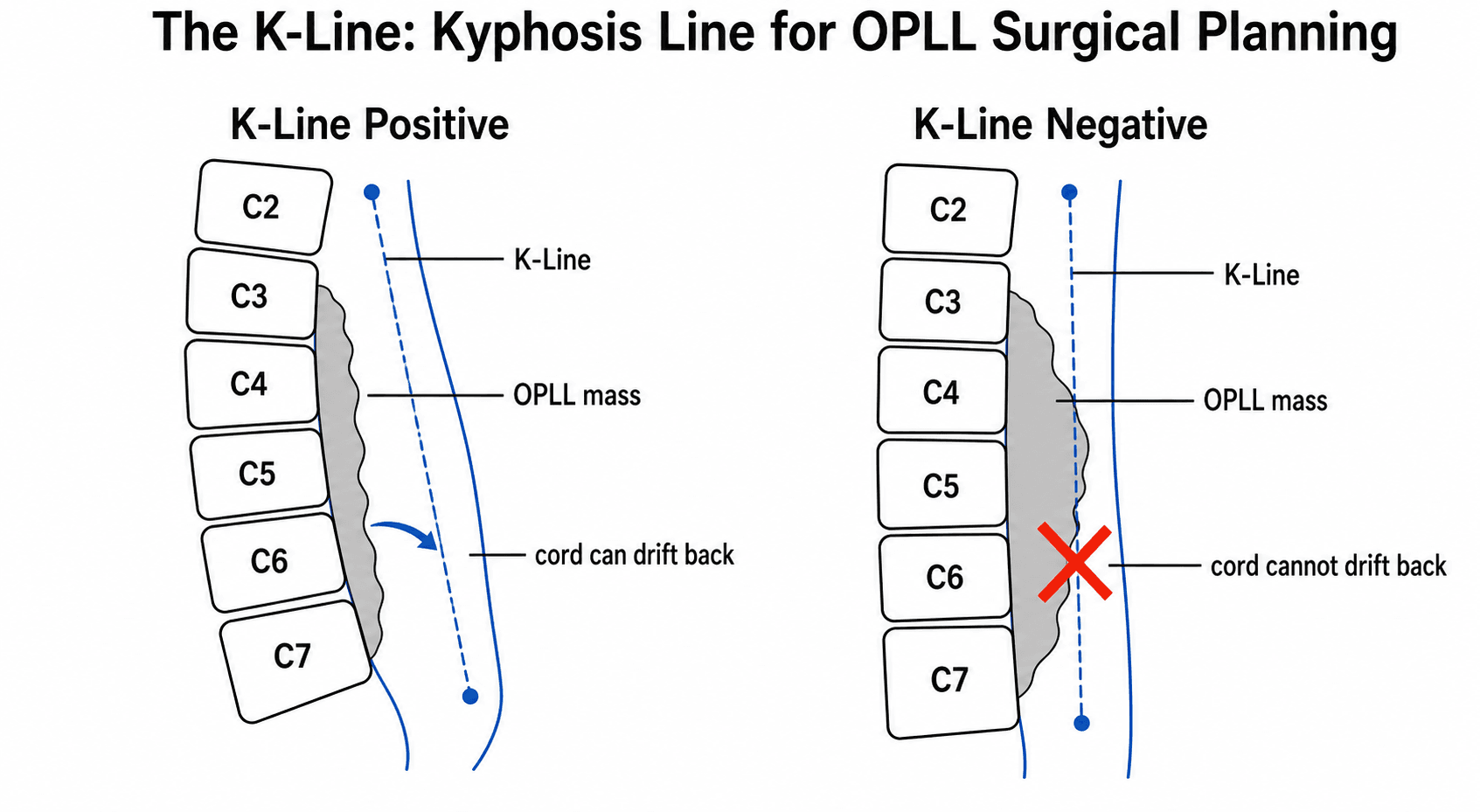Schematic comparing K-Line positive and K-Line negative cervical OPLL, showing the OPLL mass staying anterior to the K-Line versus crossing it