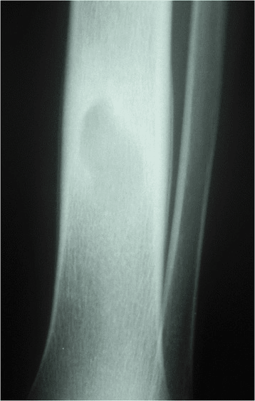 AP radiograph of the distal tibia showing an oval lucent metaphyseal lesion with a sclerotic rim