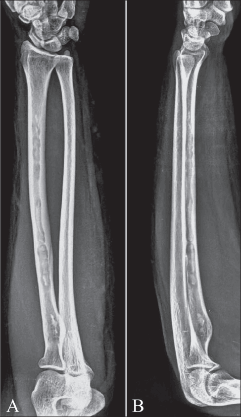 Two-panel AP and lateral radiographs of the forearm showing a thickened sclerotic radius