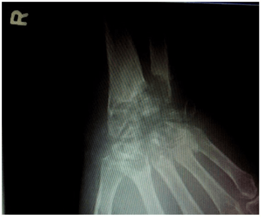 AP radiograph of the right wrist showing destruction of the distal radius, ulna and carpal bones