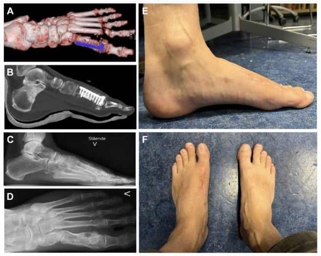 Composite CT, radiograph and clinical follow-up images after plate-and-graft reconstruction of first metatarsal bone loss from a gunshot wound.