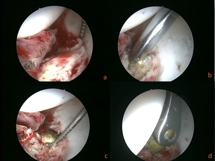 Four arthroscopic views showing exposure, mobilisation and grasper extraction of a bullet from the hip joint.