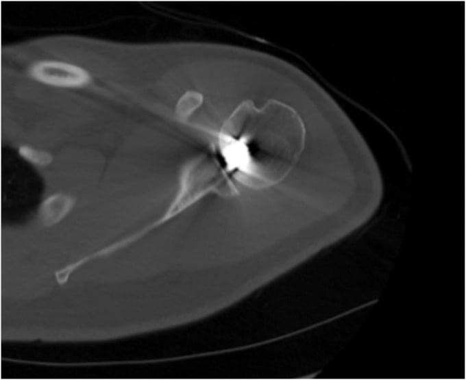 Axial CT image showing a projectile embedded in the humeral head with surrounding metal artefact.