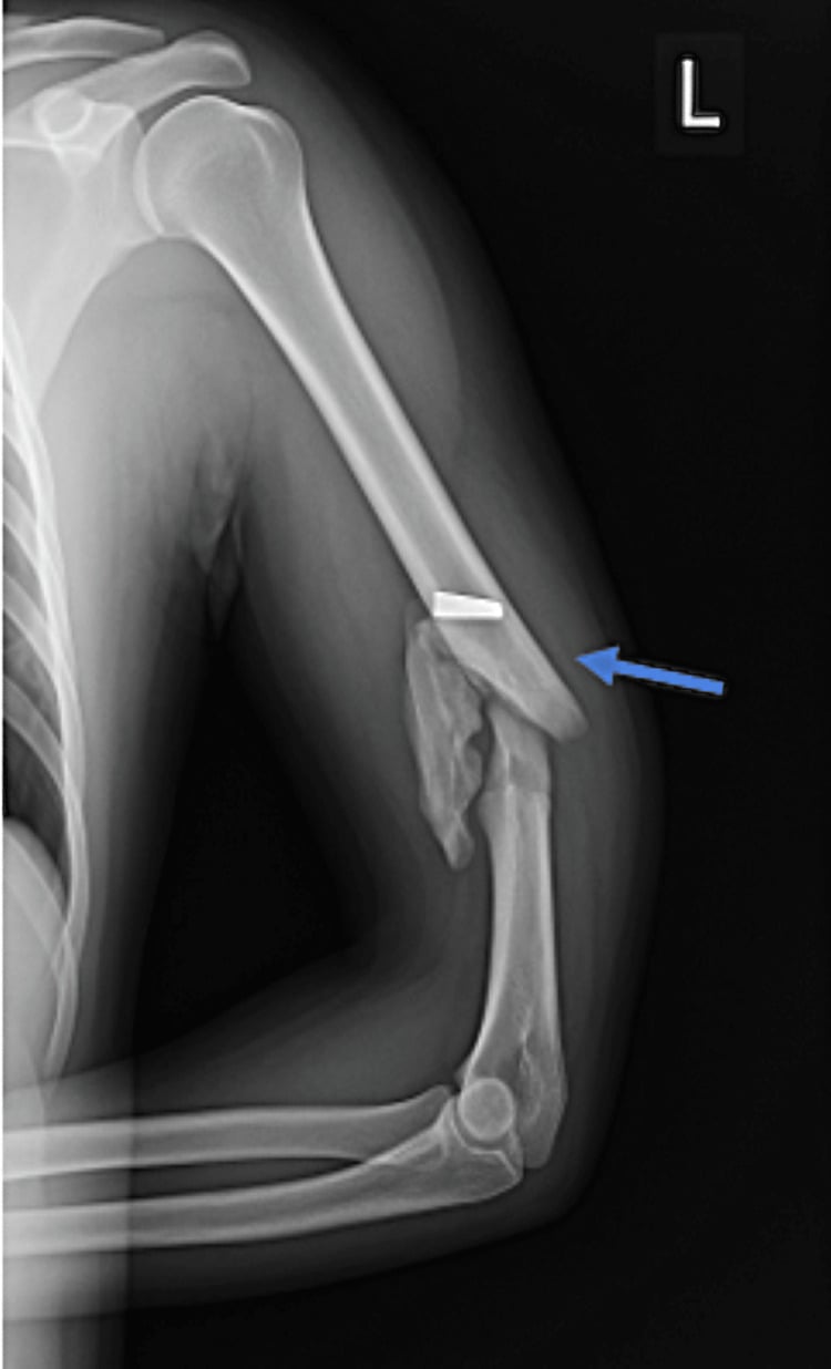 AP radiograph showing a comminuted midshaft humeral ballistic fracture with a retained projectile fragment in the arm.