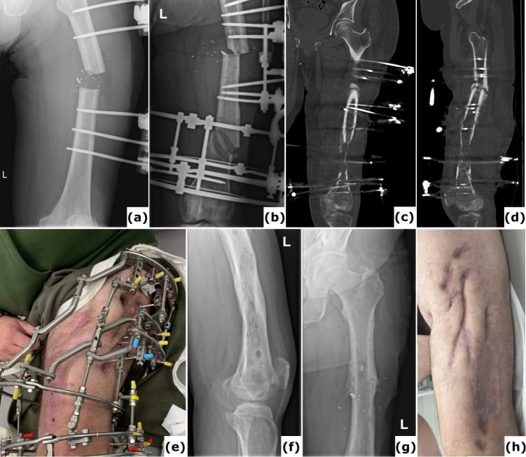 Serial radiographs and clinical images showing infected femoral gunshot fracture management with debridement, external fixation, bone transport and healed reconstruction.