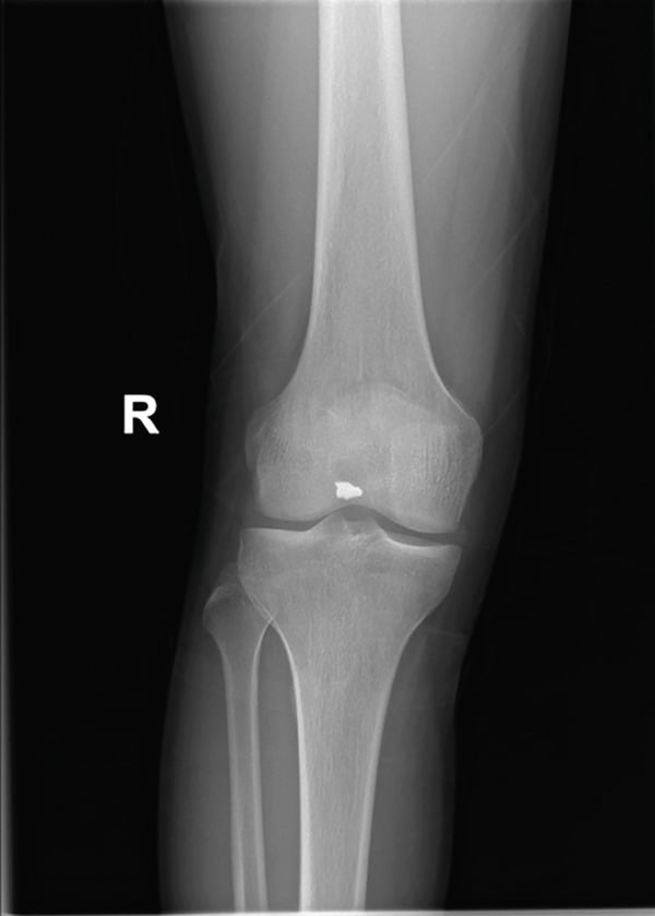 AP knee radiograph showing a retained metallic fragment projected over the intercondylar region.
