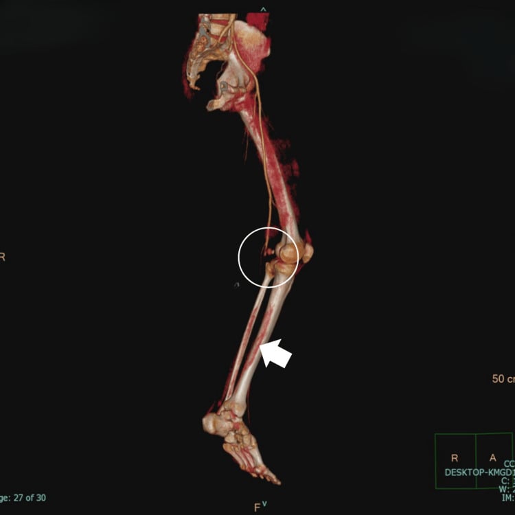 Three-dimensional CT angiographic reconstruction showing delayed popliteal artery pseudoaneurysm and distal vascular compromise after gunshot injury.