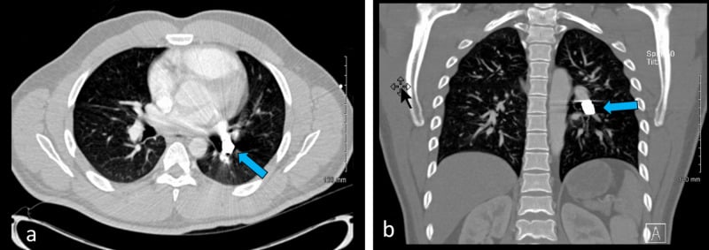 Axial and coronal contrast-enhanced CT images showing a bullet lodged in the left pulmonary artery.