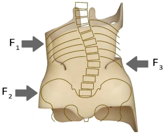 Diagram of a Boston scoliosis brace drawn over the spine and pelvis, with three force arrows labelled F1, F2 and F3.