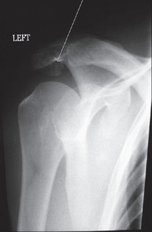 Anteroposterior radiograph of a single left shoulder. A fine marker points to the superior acromial region where an os acromiale lies. The glenohumeral joint and proximal humerus are well seen, but the acromial gap is difficult to appreciate on this AP projection.