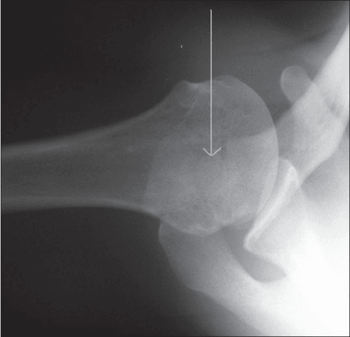 Axillary (axial) radiograph of a single shoulder. A vertical arrow points downward onto the acromion, where the separate unfused acromial bony fragment is now clearly demonstrated, lying superior to the humeral head and glenoid.