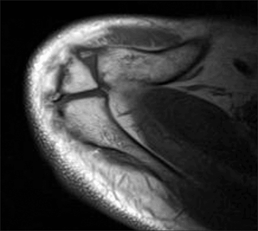 Axial T1-weighted MRI through a single shoulder at the level of the acromion, showing a cleft of low signal separating the anterior acromial fragment from the rest of the acromion - the os acromiale fusion defect.