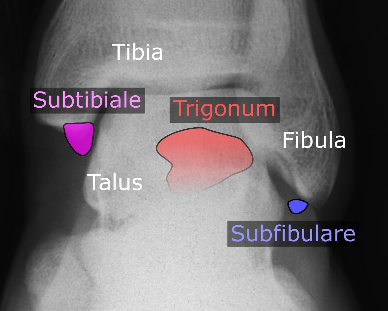 Anteroposterior ankle radiograph with the typical anatomical locations of the os trigonum and other accessory ankle ossicles overlaid and labelled