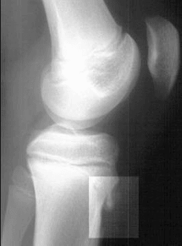 Osgood-Schlatter disease. Lateral radiograph of the knee demonstrating fragmentation of the tibial tubercle with overlying soft tissue swelling. (Radiograph courtesy of BC Children's Hospital)