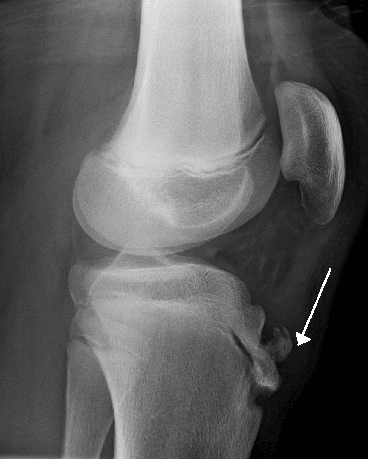 Lateral knee radiograph in an adolescent with Osgood-Schlatter disease, showing fragmentation and irregularity of the tibial tubercle apophysis with a small ossicle and overlying soft-tissue swelling marked by an arrow.