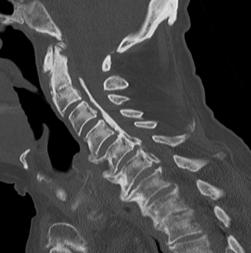 Sagittal cervical CT showing ossification of the posterior longitudinal ligament as a continuous ossified band along the posterior vertebral bodies.